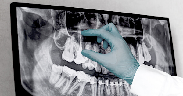 Wurzelbehandelten Zahn überkronen